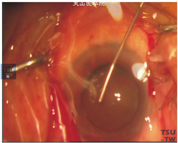 从辅助切口向前房注入足够量的粘弹剂，压平前囊膜