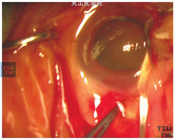 扩大切口、连续环形撕囊、粘弹剂浮核。用穿刺刀于隧道前端中点处刺入前房