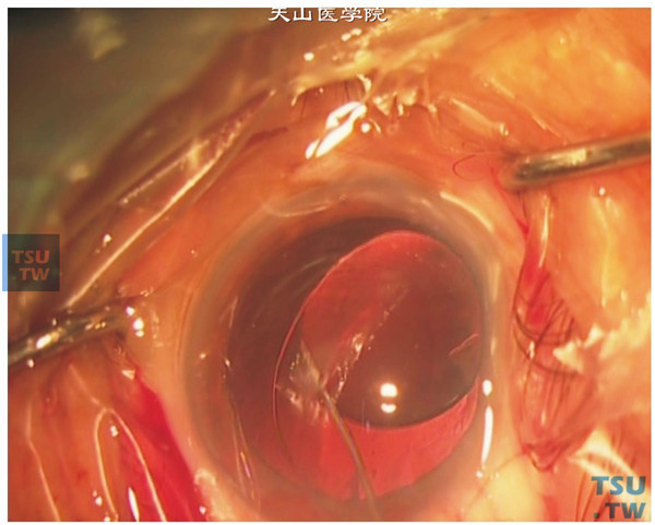 人工晶状体植入。后囊抛光后，注入粘弹剂胀开囊袋，将人工晶状体旋入袋内，吸尽粘弹剂