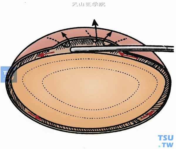 水分离。用直的或弯的灌注针将BSS注入皮质和囊膜之间