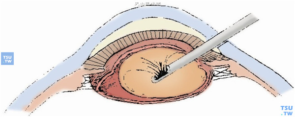 用注吸系统（I/A）的注吸头清除晶状体残余皮质及部分核周组织