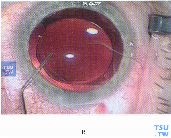将人工晶状体植入囊袋，并调整为水平位