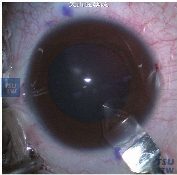 有晶状体眼后房型人工晶状体植入术操作