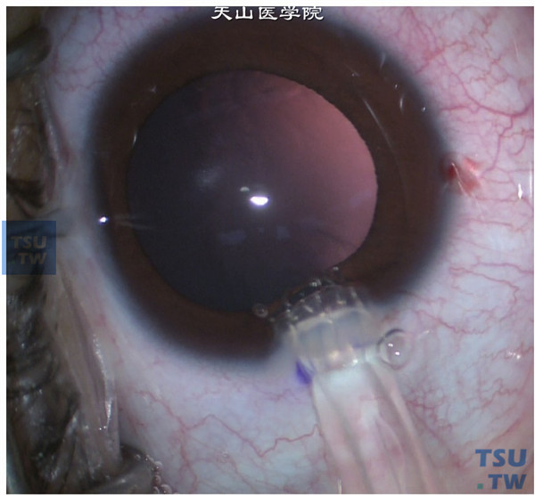  将晶状体舱前段插入透明角膜切口，开始将晶状体推入前房