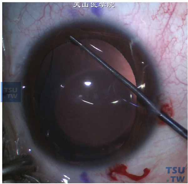  用调位钩将晶状体的四个脚板依次移入虹膜后