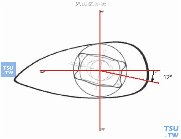  TICL晶状体植入后旋转的度数及方向指示图