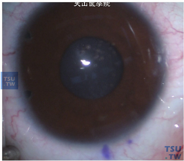  注入缩瞳剂后瞳孔缩小，并可见虹膜根切孔（2个）开放