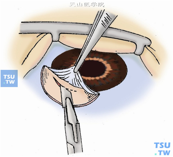 青光眼周边虹膜切除术操作及注意事项