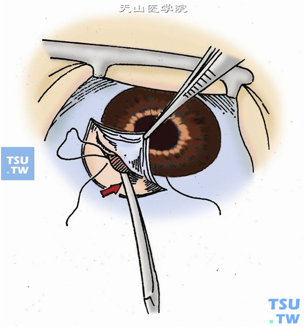用虹膜整复器轻轻压迫切口的巩膜侧（后唇），可见周边虹膜自动脱出于切口处，瞳孔向切口方位移动