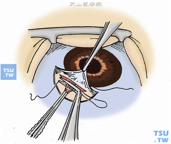 用显微虹膜镊夹住已脱在切口处的周边虹膜，虹膜剪紧贴切口平面，方向与角膜缘平行，做一虹膜剪除
