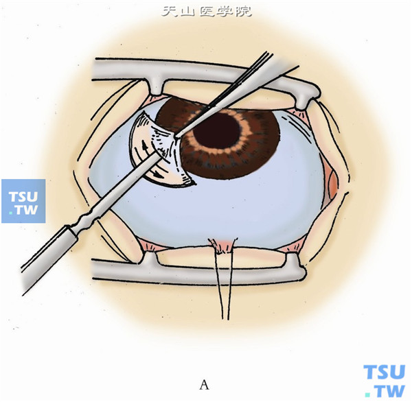 用虹膜整复器将嵌在切口内的虹膜自切口两端轻轻向切口中央推送