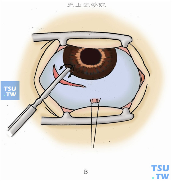 激光周边虹膜切除术图片