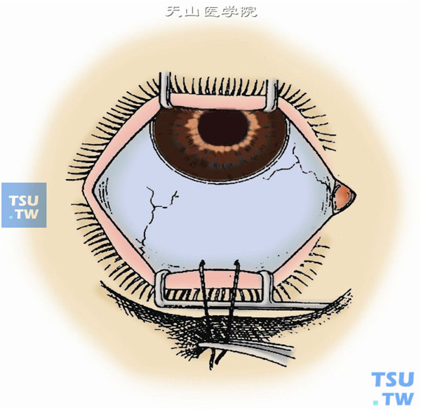 开睑器及眼球牵引固定同周边虹膜切除术1图A