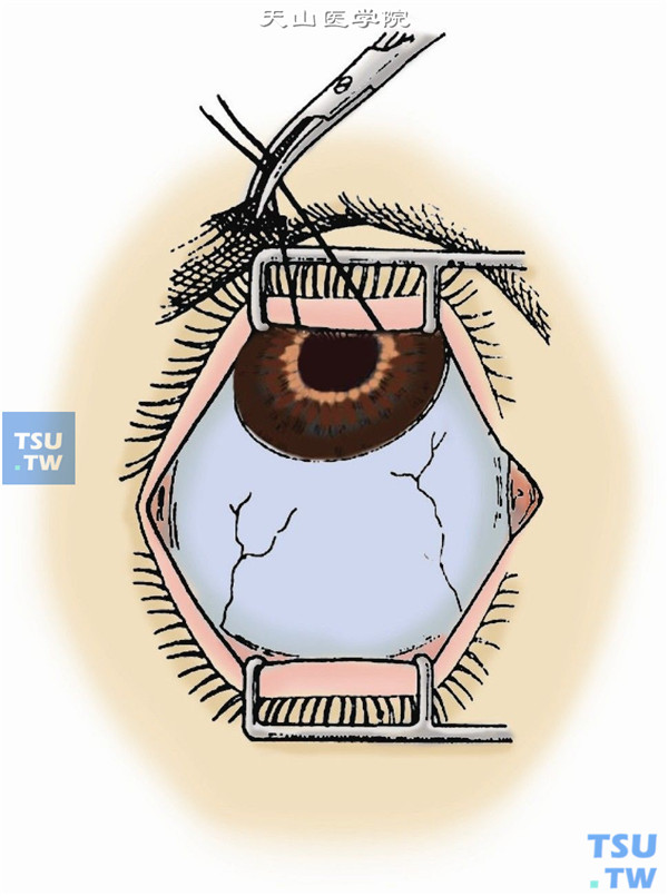 开睑器及眼球牵引固定同周边虹膜切除术1图B