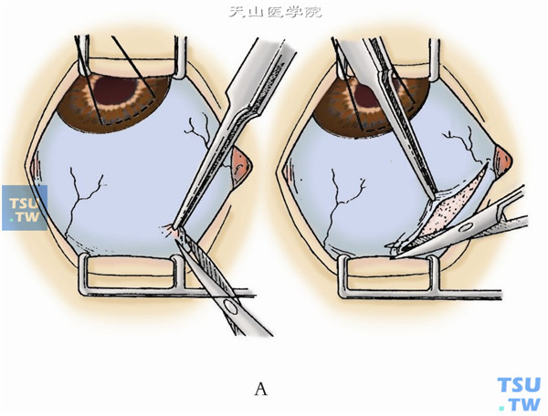 通常选择上方为手术区域，在远离预计做滤过区域的球结膜处进针作结膜下注射麻醉剂1～2ml。做以角膜缘为基底的结膜瓣时应在距离角结膜缘至少8mm高的球结膜处剪开球结膜，并逐层剪开球筋膜，向前分离到较好暴露角巩膜缘半透明区