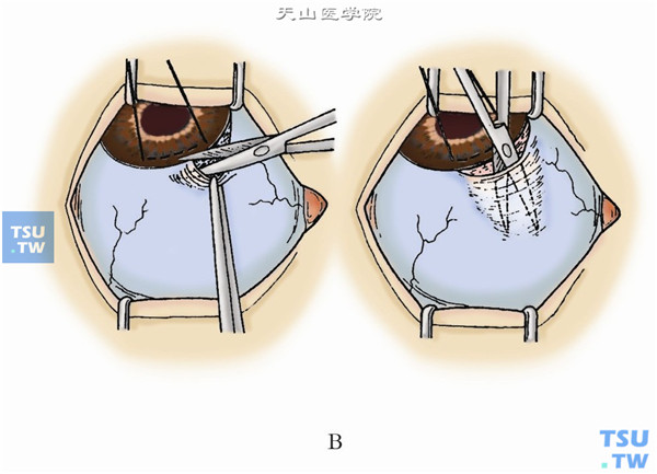 如做以穹窿部为基底的结膜瓣，则在角结膜缘处剪开球结膜和球筋膜并于一侧做纵形剪开长约5～8mm，向后分离到较好暴露巩膜区域