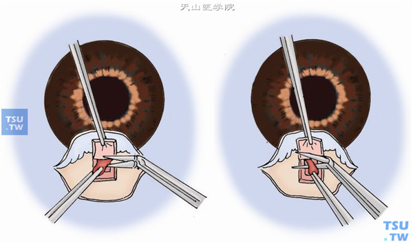 用虹膜镊夹住暴露在滤过口内的虹膜稍上提，用虹膜剪或小梁剪平行角膜缘方向做一宽基底的周边虹膜剪除，缺损边缘应超过滤口范围。在巩膜瓣或结膜瓣外按摩小梁切除处，整复虹膜，通常上方虹膜缺损区清楚可见。但有明显老年环时不易看到，这种状况下只要使瞳孔恢复到居中位置并呈圆形即可