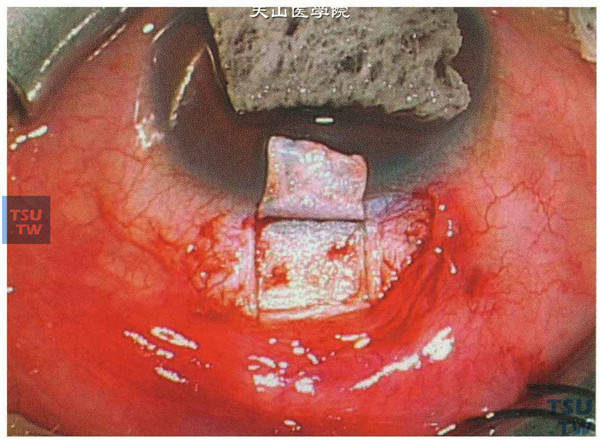 先做一较薄的、较小梁切除术略大些的巩膜瓣，在已止血区域巩膜上制作5mm×6mm约1/3厚度的巩膜瓣，在此平面剥制巩膜瓣到角膜的透明区内约1mm