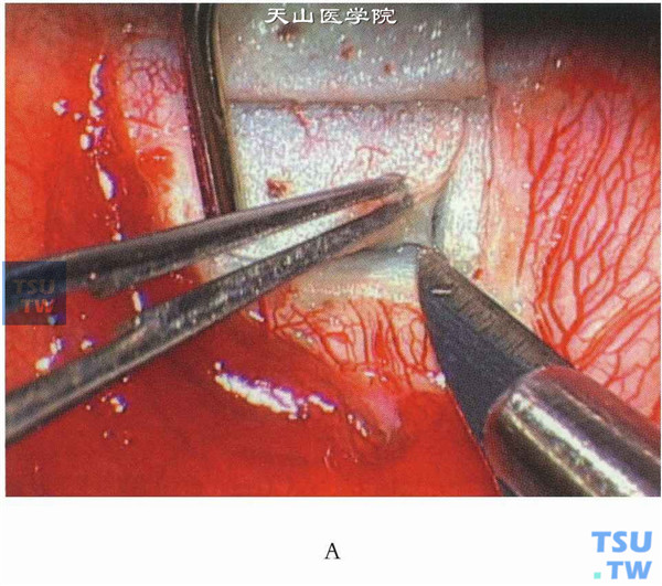 然后调整手术显微镜至更大倍数（通常要10～12倍），于已做好的巩膜床上再作梯形（底边长3.5mm）的层间巩膜瓣，其深度达透见浅蓝色睫状体组织但又未穿透（约90%～95%的巩膜厚度）