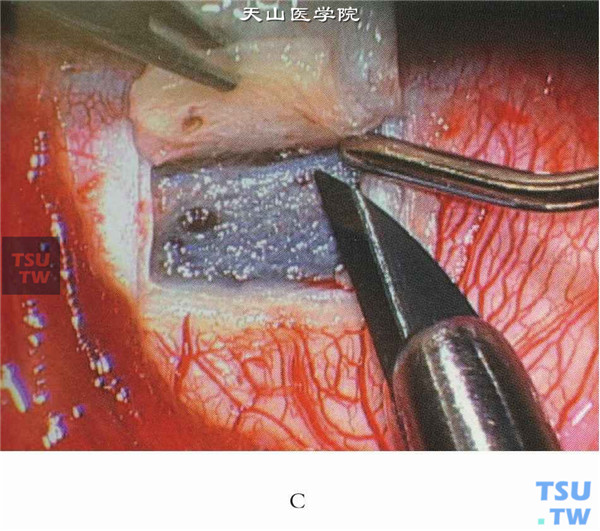 在管腔的前端继续用锋利的刀尖在这一平面向透明角膜方向剖切角巩膜缘组织约0.5mm即可
