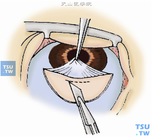青光眼虹膜嵌顿术操作及注意事项
