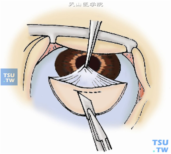 在巩膜床的角巩膜缘半透明过渡带的中间做一垂直切口进入前房，切口长度为5mm