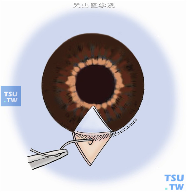 一旦Schlemm管的外侧壁被切开，常可见到清澈的液体缓缓渗出而前房深度并不改变。取一段长约3cm的5-0黑色尼龙线自切开的一侧断端口插入Schlcmm管。如位置正确，则可毫无阻力地深入管内1cm以上。摆动未插入的游离线段时插入管内的线段仍保持在腔内不移位，则可以肯定所切开的确是Schlemm管。以同样方法可做另一侧探通证实