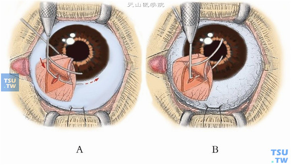 眼睛小梁切除术图片