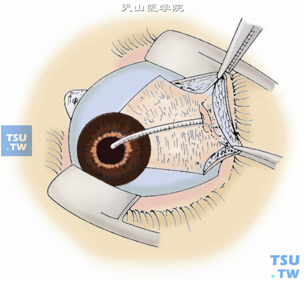 将减压阀前部的房水引流导管根据置入前房约2mm的长度将导管进行修剪，并使其头端呈面向角膜的斜面开口