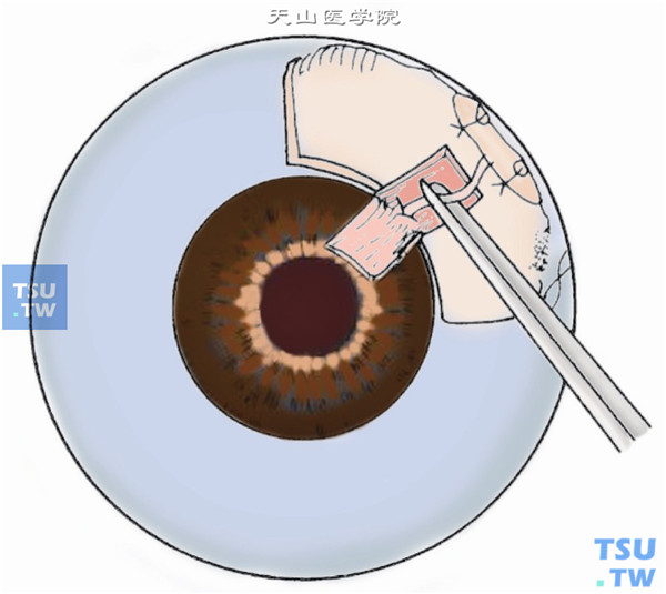 退出穿刺针后，即将修剪好的房水引流导管沿穿刺隧道插入前房内，以巩膜表面的导管平覆后前房内见到2mm的导管为好，如果较长但不超过瞳孔缘也可，否则应退出再做适当修剪。注：该图是剥制巩膜瓣的手术，现多不采用了。
