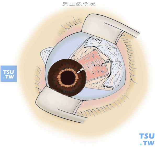 在巩膜穿刺口处用8-0可吸收缝线或10-0尼龙线将导管松松地固定在巩膜表面，达到不移位即可，切勿结扎太紧阻断房水的引流。