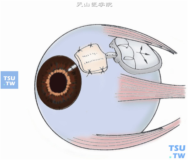 并取去抗原、消毒的异体生物膜（如异体巩膜、硬脑膜、心包膜等）约3mm×5mm大小覆盖在该处导管上，并用缝线固定于巩膜表面