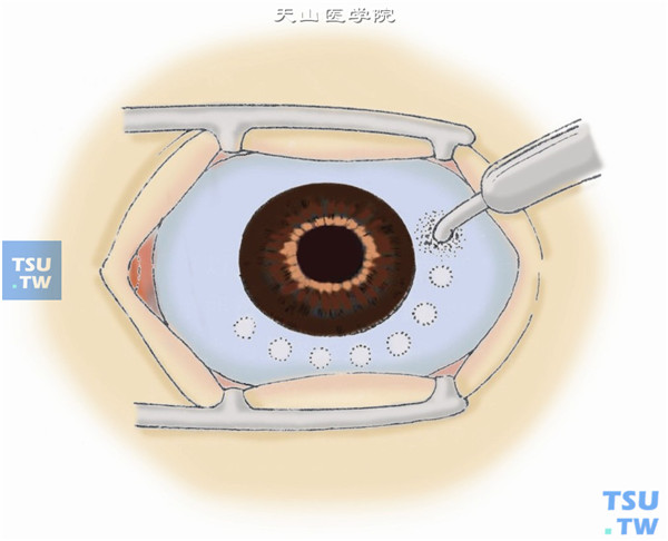 青光眼睫状体冷凝术操作及注意事项