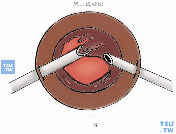 伴有眼后段病变如玻璃体积血、视网膜脱离，应从睫状体扁平部进入