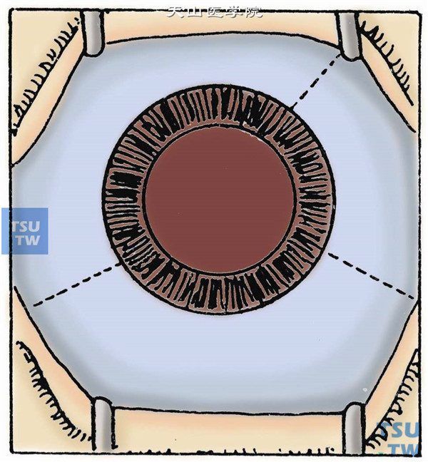 置开睑器。在颞侧上、下及鼻上各做一L形结膜与眼球筋膜切口，暴露巩膜，水下电凝止血
