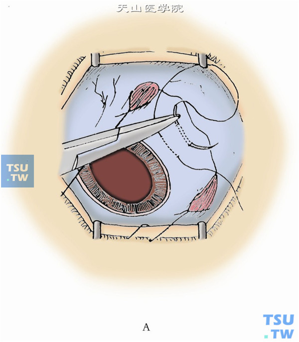 有晶状体眼距角膜缘4mm，无晶状体眼或拟摘除晶状体眼距角膜缘3.5mm。颞下象限做一蹄系缝线，分开线圈。