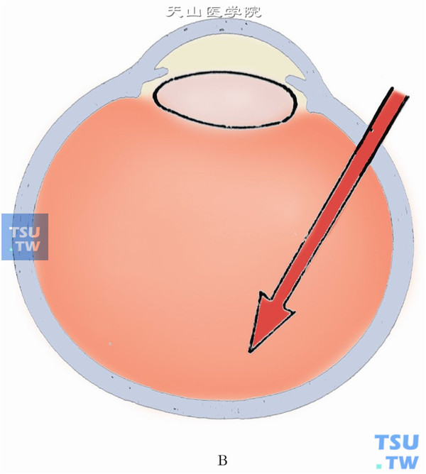 用显微玻璃体视网膜（MVR）刀，经巩膜垂直刺入眼内。再做颞上及鼻上切口