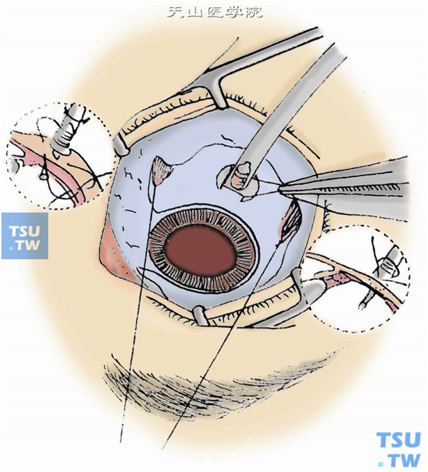 颞下切口插入灌注针。通过角膜观察，确认灌注管在玻璃体腔后，开放灌注管进液。结扎蹄系线，将灌注针固定在巩膜上