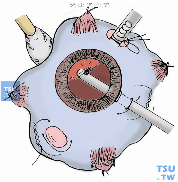 结束手术前，必须顶压周边巩膜一周，检查有无周边医源孔，如有，用光凝或冷凝封闭