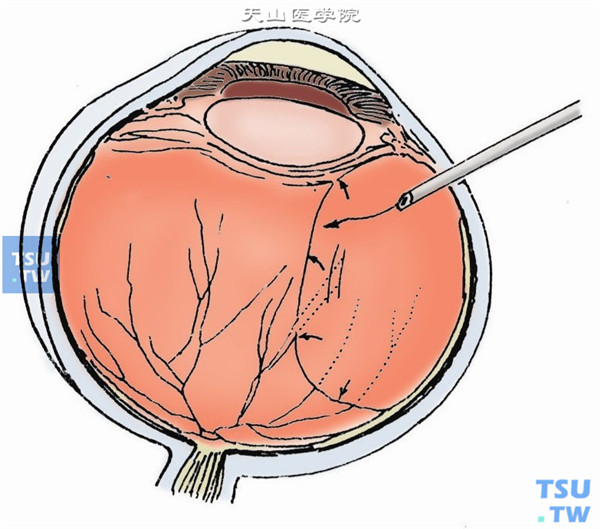气体视网膜粘结术操作