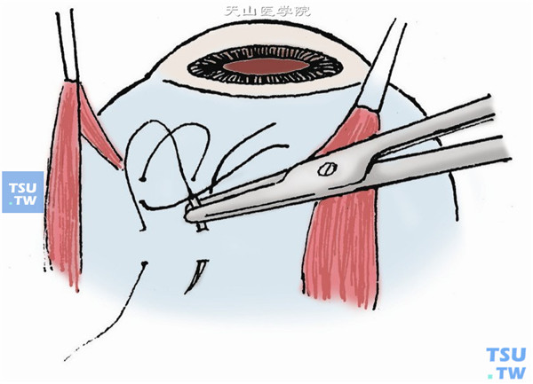 5-0不吸收缝线，作蹄系缝合将硅胶或硅海绵固定在巩膜表面。蹄系缝合两针间距应比硅胶块宽度大2～3mm，如硅胶宽7mm，间距应为9～10mm，结扎后方能使加压块下陷起到顶压裂孔的作用。缝针深度应达巩膜1/2～2/3厚。根据加压块长短，作2～3对蹄系缝合，通常每象限2对