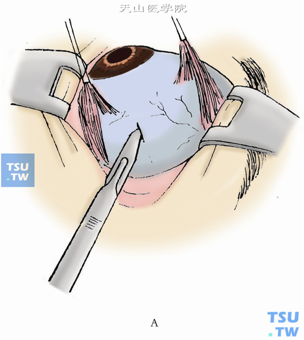选定放液位置后，层间切开巩膜约1mm长，结核菌素细针头刺穿残存的巩膜与脉络膜，即见网膜下液体流出，轻压球壁促使液体持续外流