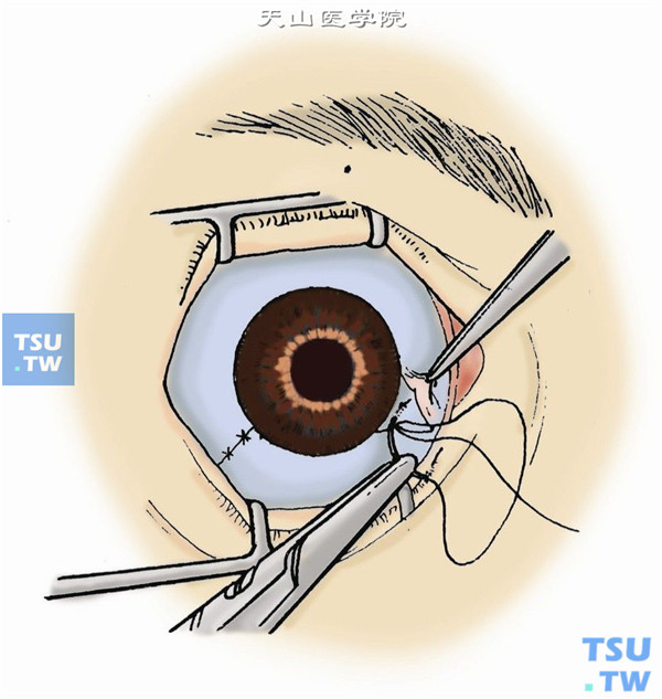 稀释妥布霉素液冲洗手术野，8-0吸收线分层缝合眼球筋膜与结膜。涂1%阿托品眼膏与妥布霉素眼膏，眼垫包眼