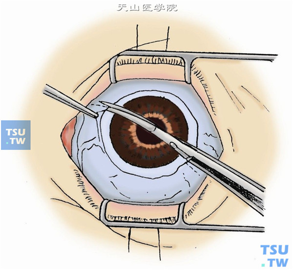沿角膜缘剪开球结膜，在3点与9点时钟位加做2个水平切口