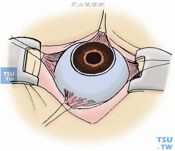 巩膜环扎术操作解读
