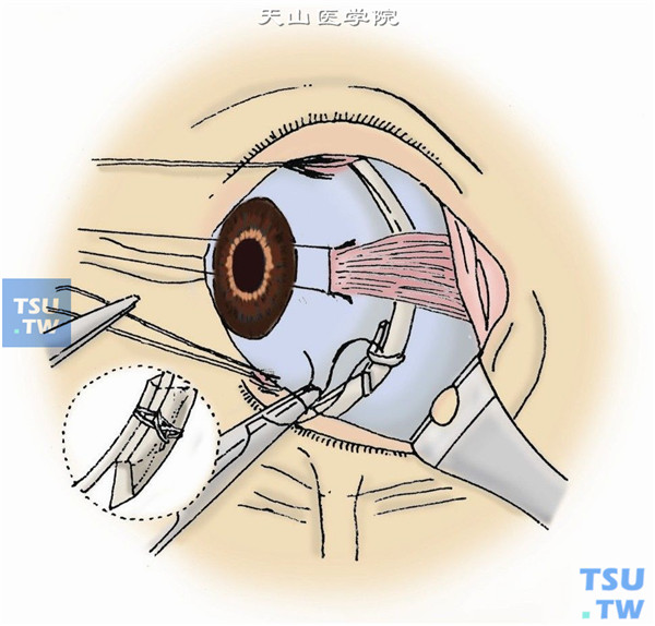 将2.5mm宽的硅胶环扎带置于轮胎型硅胶槽内，在蹄系缝线线圈与直肌下穿过，环绕眼球一周后与硅胶带的另一端相互连接