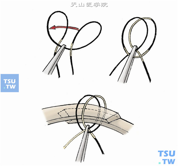 连接方式有双套结结扎；或用一小段硅胶管，将环扎带的两端分别从两头插入硅胶管内再从对侧抽出