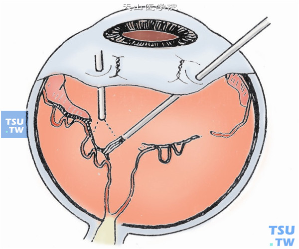 用钩针、玻璃体镊或剪，或快速切割头去除视网膜前增殖膜，使视网膜完全松解