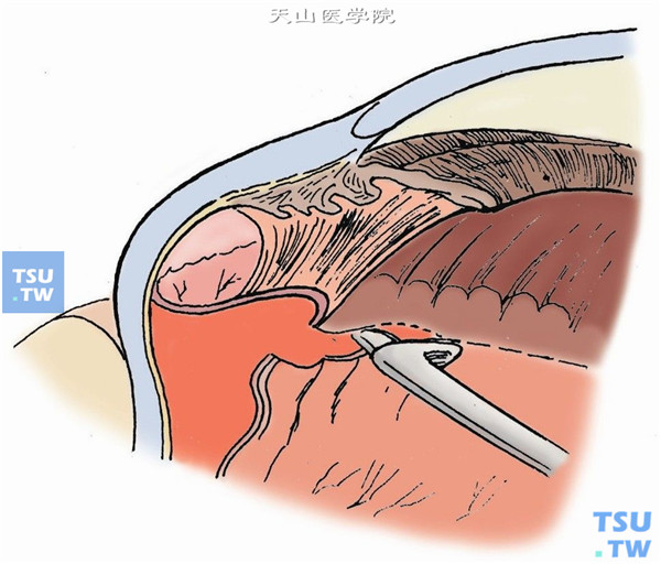 复杂性视网膜脱离的玻璃体手术操作