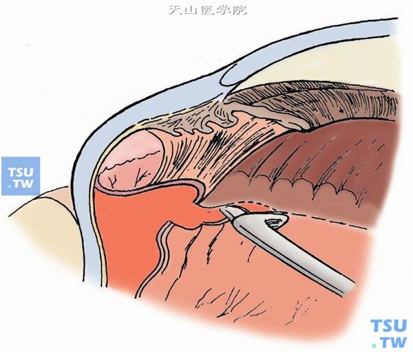 视网膜明显缩短不能复位时，做视网膜切开或切除